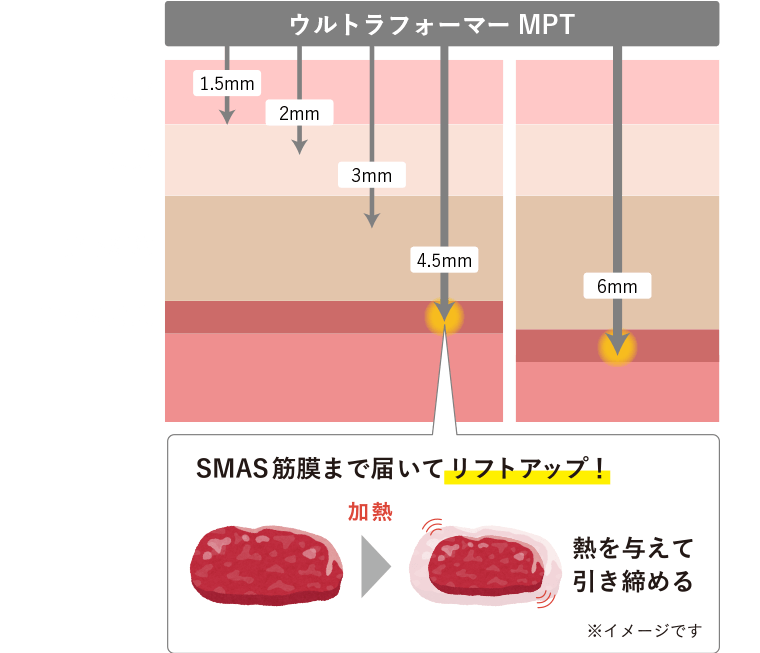 ハイフ治療とは